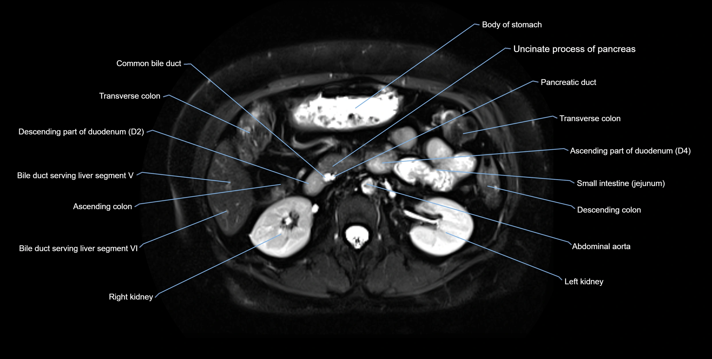 MRI MRCP axial cross sectional anatomy 3T radiology  image-img-10001-00028.webp